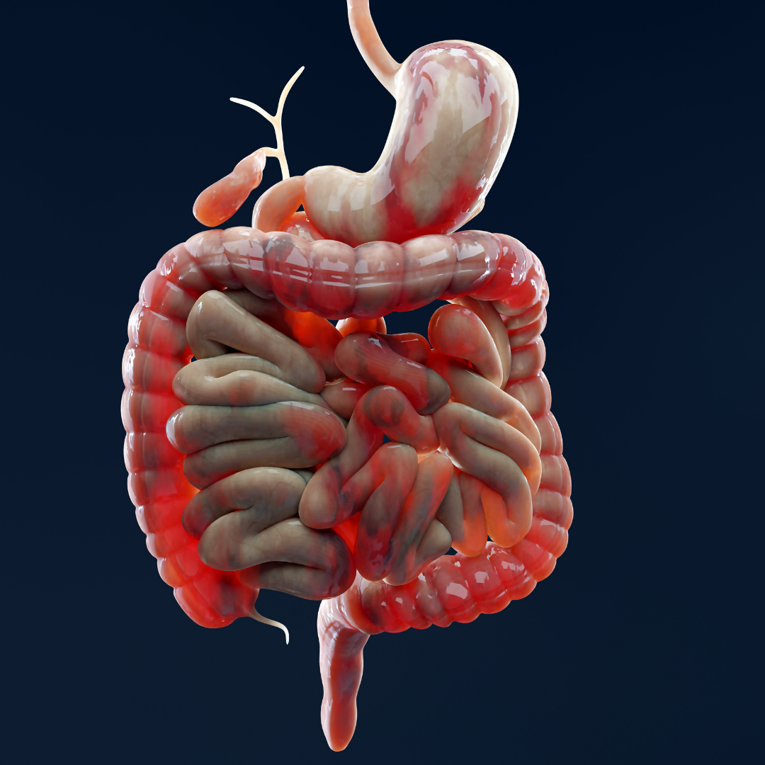 Representação anatômica do intestino com áreas inflamadas