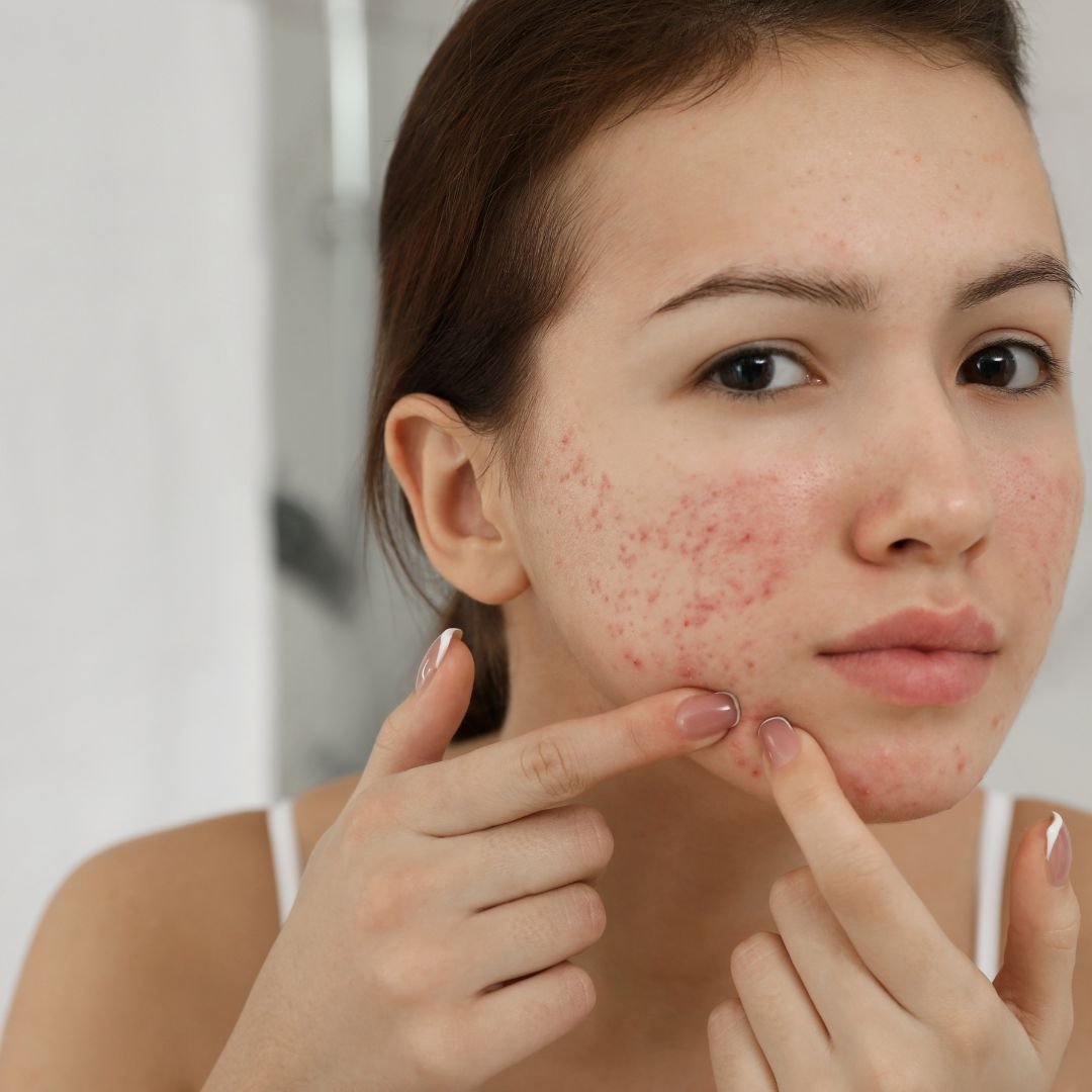 Mulher com acne no rosto observando a pele no espelho