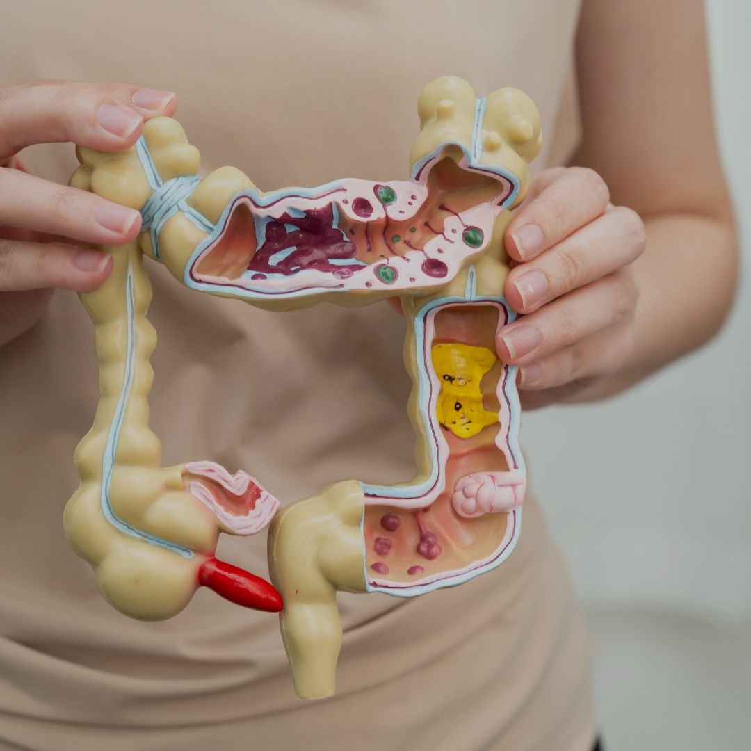 Mulher segurando representação do intestino com áreas inflamadas